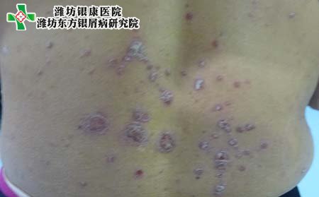 牛皮癣患病原因,牛皮癣发病原因