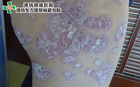 斑块银屑病病因,为什么得斑块银屑病