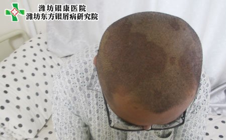 头部牛皮癣护理,头部牛皮癣怎样按摩
