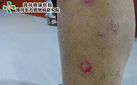 银屑病症状表现,银屑病最初症状表现