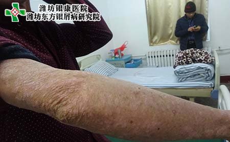 银屑病注意事项,银屑病运动注意事项