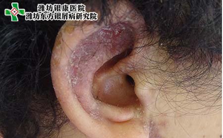 男性长银屑病怎么办,男性有银屑病怎么办