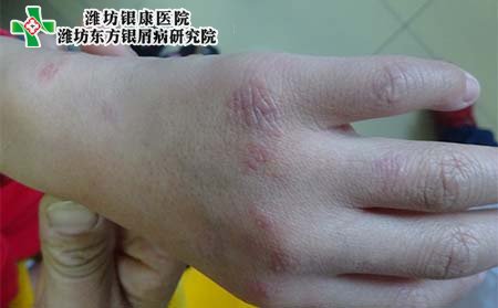 女性银屑病常识,女性银屑病防治