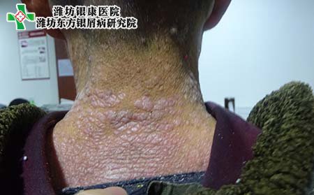 牛皮癣病因,导致牛皮癣的原因