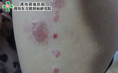 银屑病症状图片,银屑病有什么症状