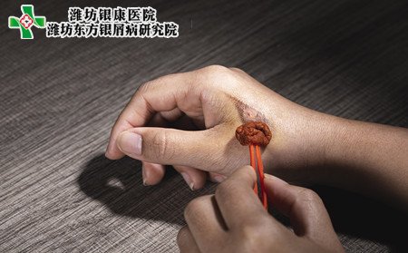 外伤加重银屑病吗,银屑病受外伤影响吗