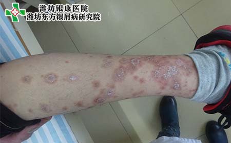 腿部牛皮癣怎么办,牛皮癣在腿上怎么办