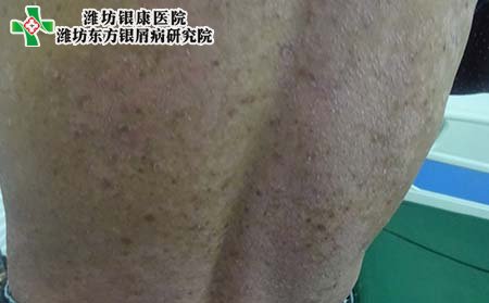 牛皮癣症状,背部的牛皮癣症状