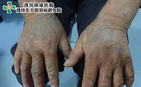 银屑病症状,手部银屑病症状