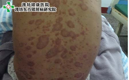 牛皮癣治疗,牛皮癣痒要如何治