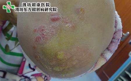 牛皮癣症状,患牛皮癣的症状