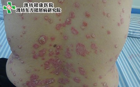 牛皮癣症状,背部牛皮癣的症状