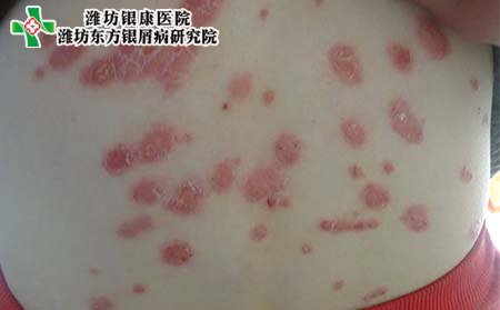 牛皮癣症状,牛皮癣具体症状