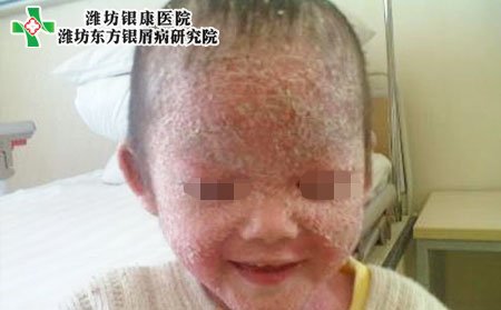 儿童牛皮癣该如何治疗?