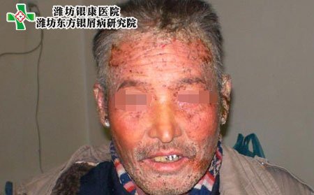 牛皮癣的治疗方法有哪些?