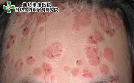 遗传病患者运动时该注意什么