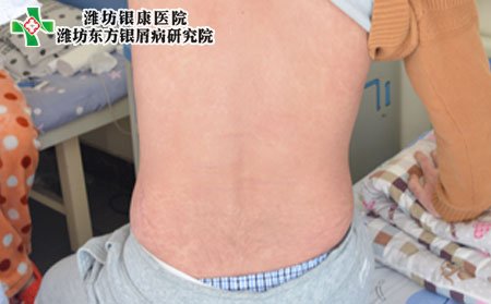 牛皮癣该如何预防?