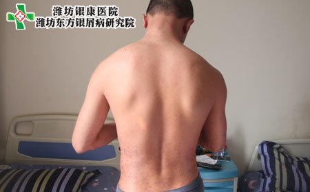 牛皮癣会引起哪些症状?并发症有哪些?